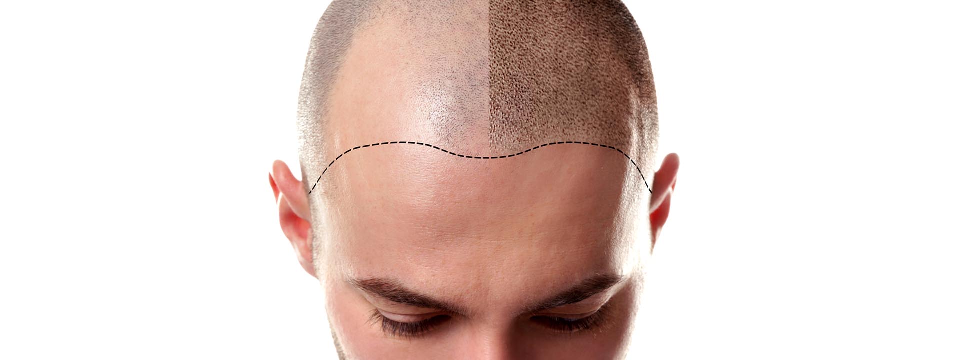 Przeszczep włosów Lublin