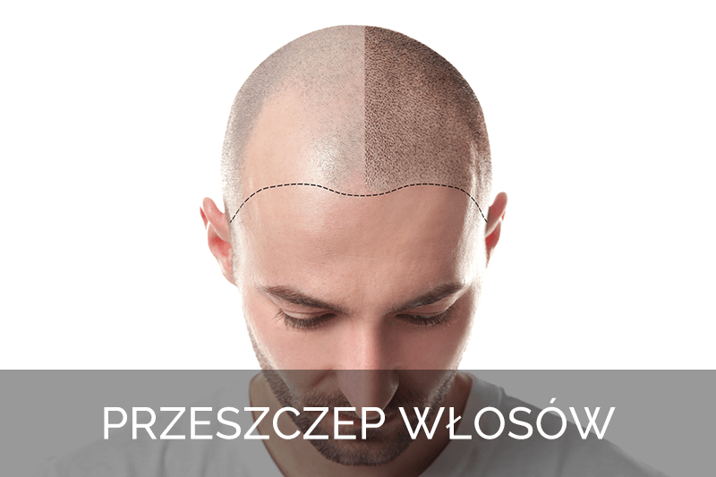 przeszczep wlosow Lublin