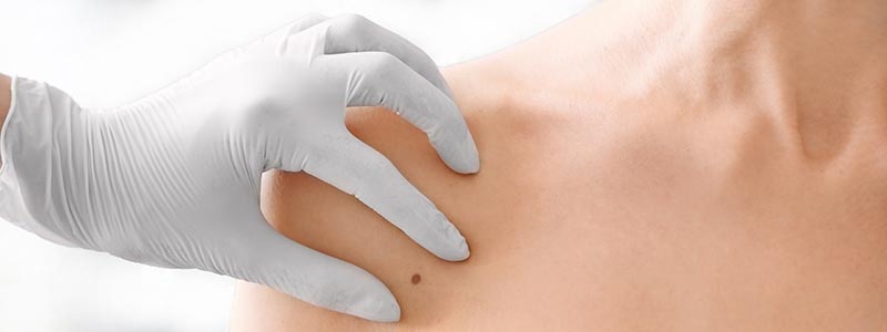 Usuwanie znamion Lublin